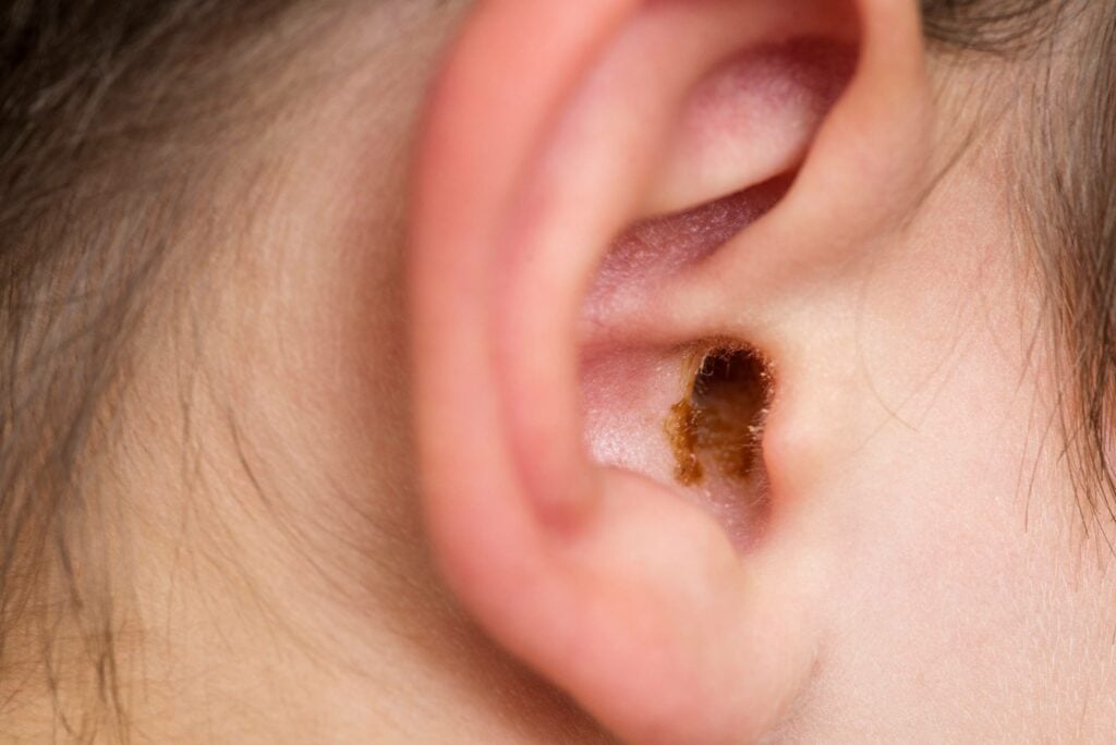 Ear Wax
