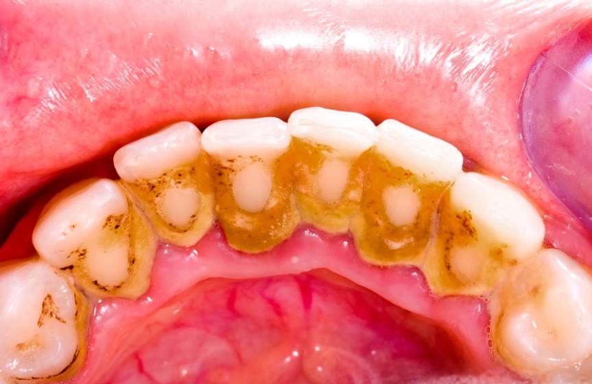 Tooth plaque
