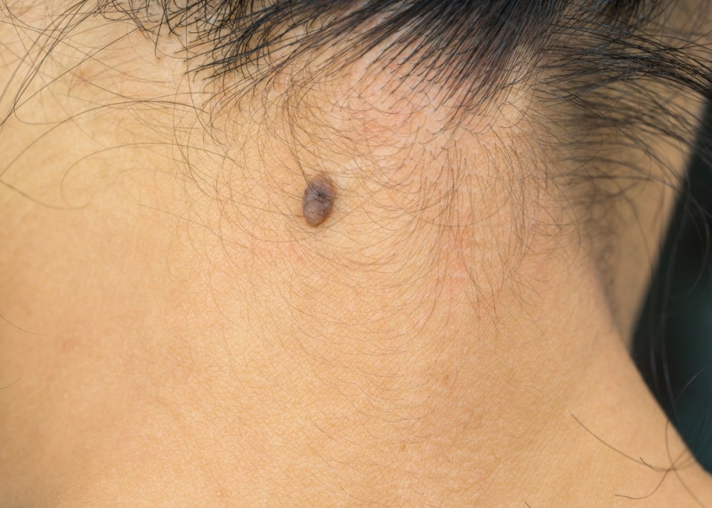 woman with black mole on back neck