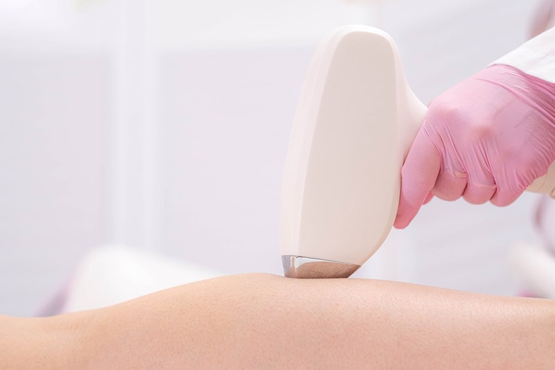 diode laser hair removal
